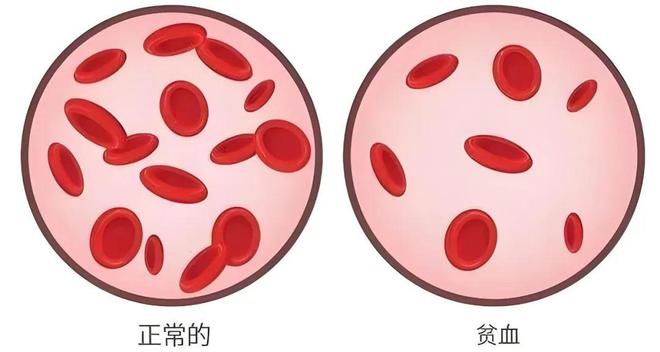 澳门沙金(中国)在线平台关于贫血你了解多少？(图5)